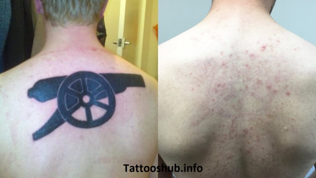 Does Tattoo Removal Hurt? 10 Laser Tattoo Removal FAQs 2025 Does Tattoo Removal Hurt? 10 Laser Tattoo Removal FAQs 2025