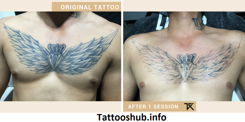 Does Tattoo Removal Hurt? 10 Laser Tattoo Removal FAQs 2025 Does Tattoo Removal Hurt? 10 Laser Tattoo Removal FAQs 2025